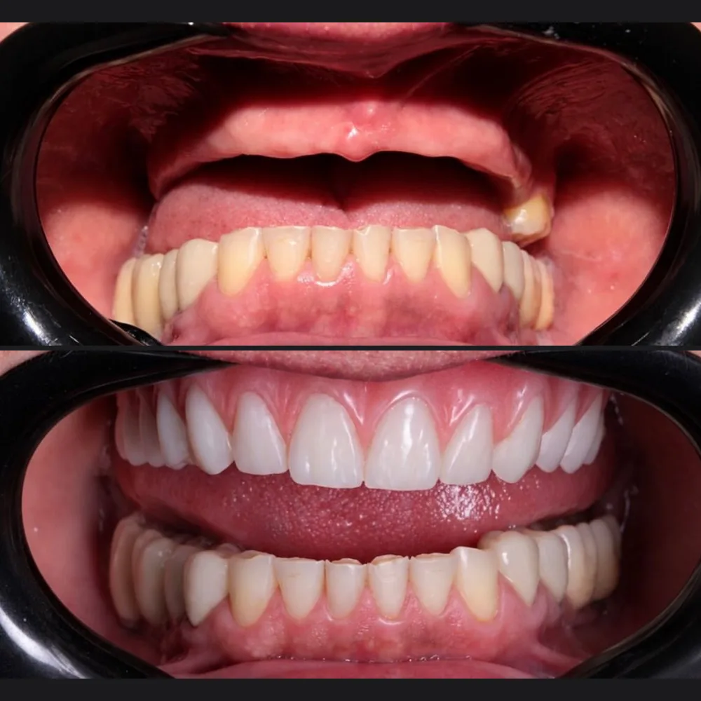 Paciente do Dr. Arcanjo Victor antes e depois da reabilitação com prótese protocolo