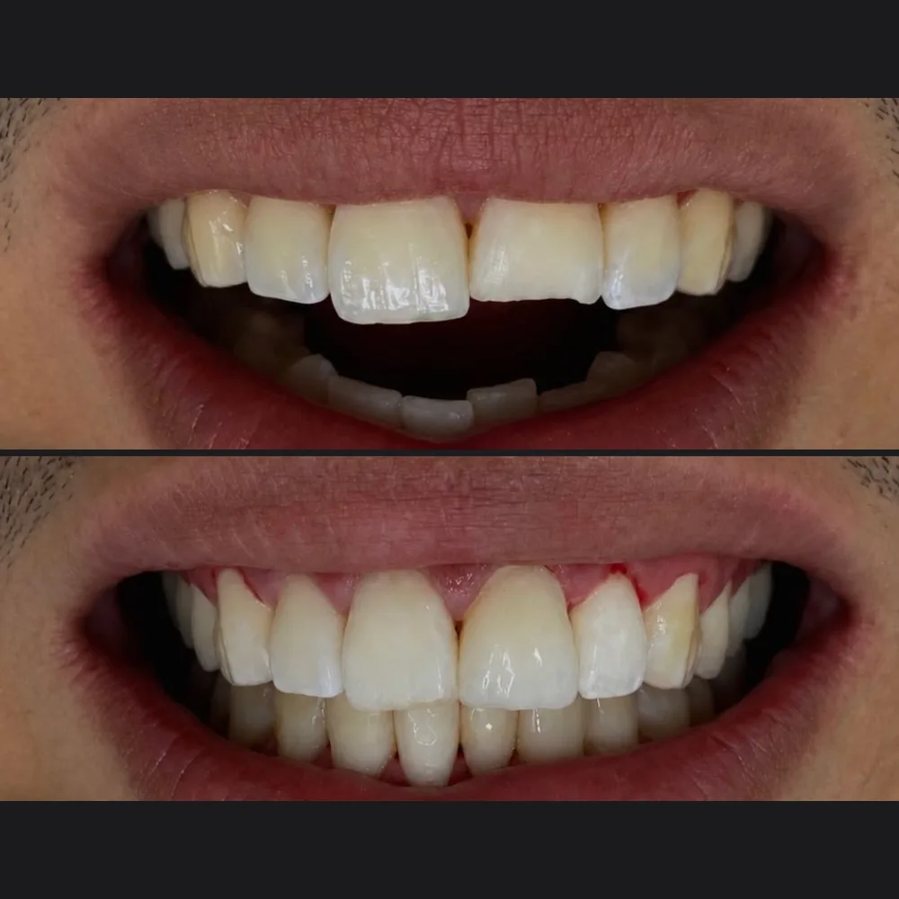 Paciente do Dr. Arcanjo Victor antes e depois da reabilitação dos dentes da frente