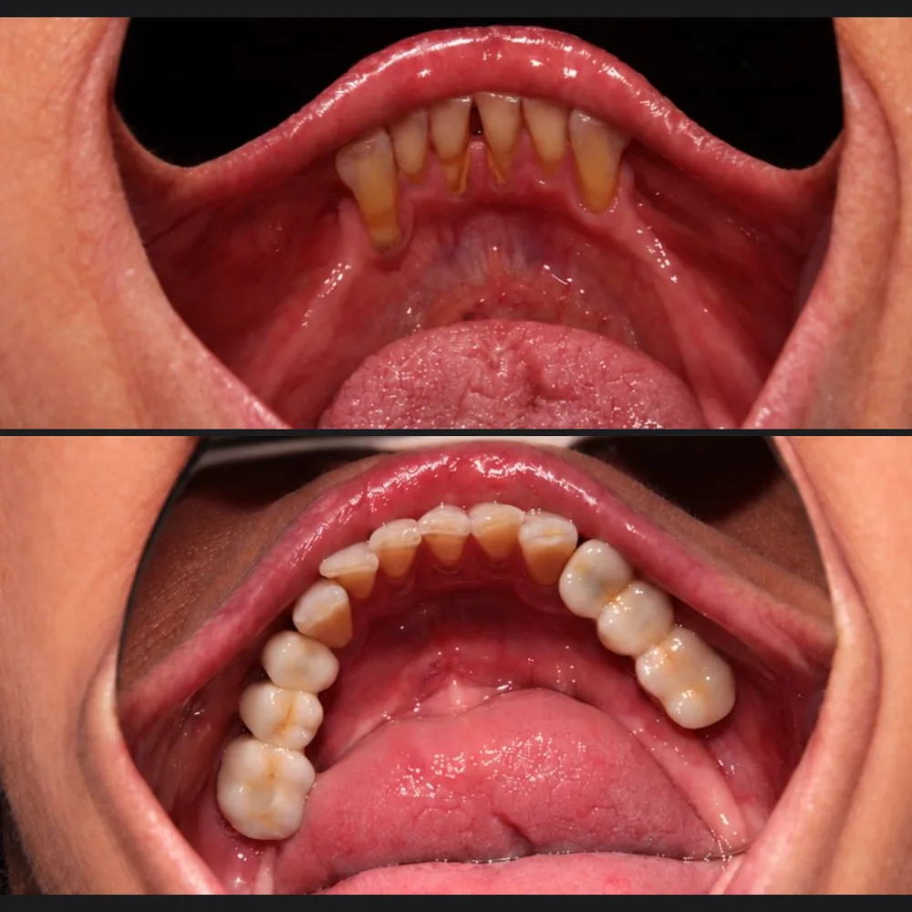 Paciente do Dr. Arcanjo Victor antes e depois das coroas sobre implantes na arcada inferior