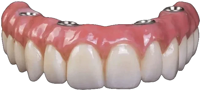 Prótese de dentes fixos parafusada sobre implantes